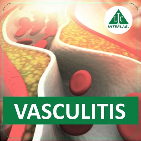 Vasculitis