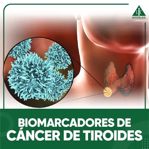 Biomarcadores de Cáncer de Tiroides