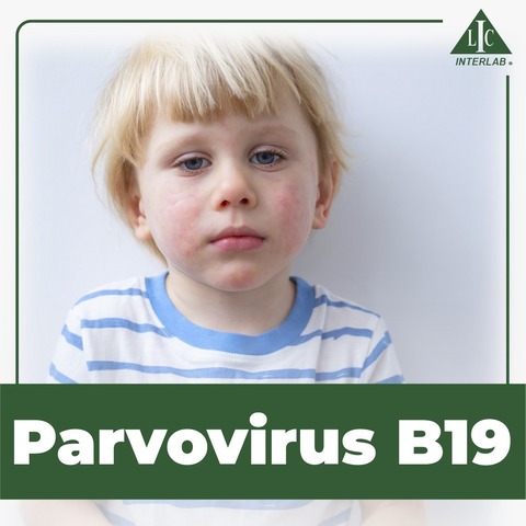 Parvovirus B19